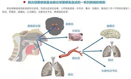 肺炎進展最新動態(tài)，科學研究的突破與希望展望