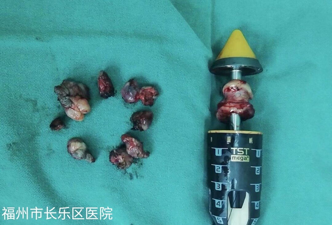 最新痔除根，一段輕松有趣的治愈之旅