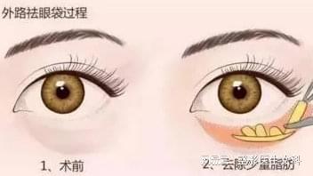 科技之光重塑魅力雙眸，最新眼袋手術(shù)技術(shù)揭秘